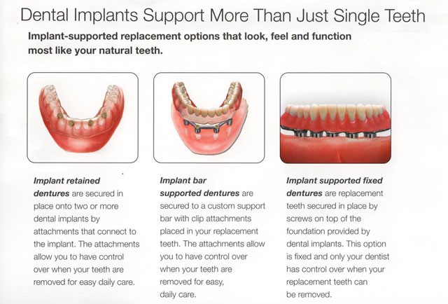 Immediate Dentures Procedure Brandt SD 57218